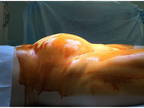 Пациентка на операционном столе (начало операции). Живот увеличен в размере за счёт гигантской миомы матки, соответствующей доношенному сроку беременности