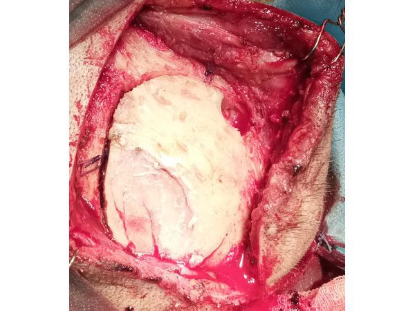 Вид операционного поля после укладки костного лоскута