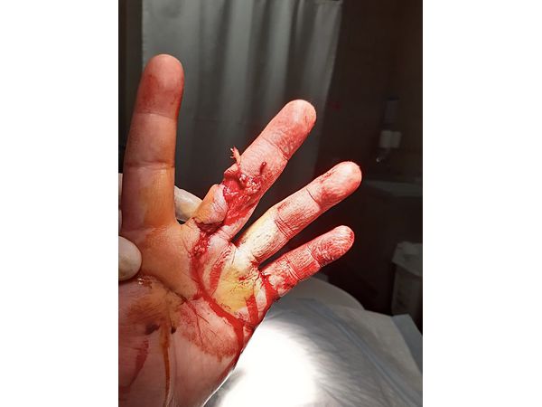 Обширная рваная рана среднего пальца левой кисти