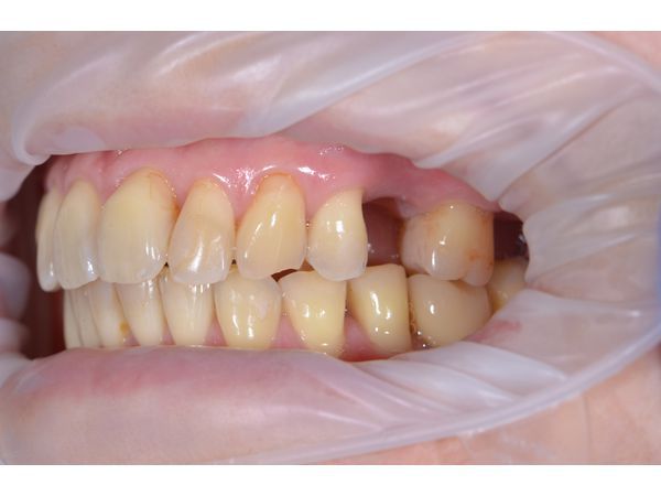До лечения: отсутствие зуба 25