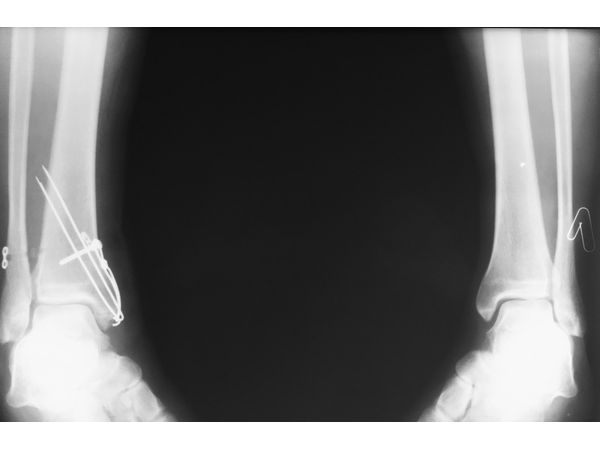 Рентгенограмма после операции в проекции Mortis