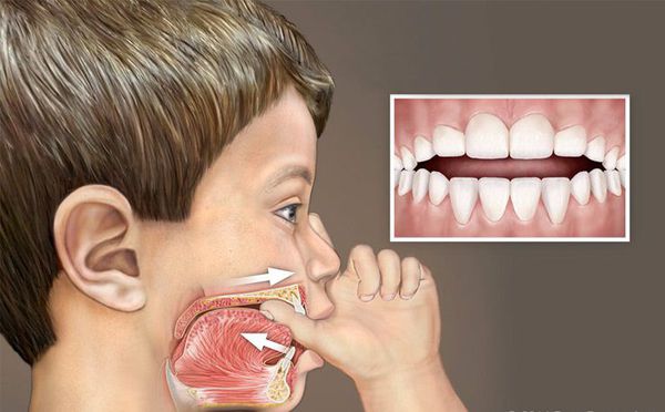 Сосание пальца влияет на формирование зубных дуг