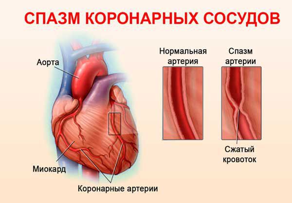 Спазм сосудов коронарной артерии
