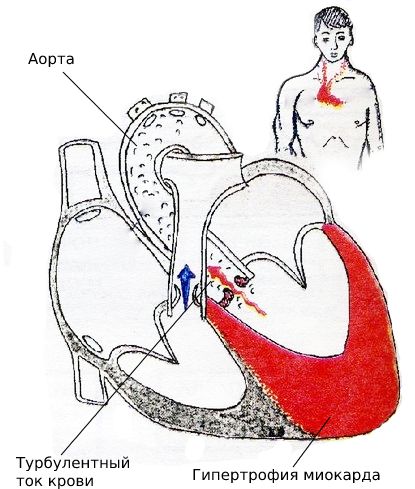 Стеноз аорты, гипертрофия миокарда левого желудочка и турбулентный ток крови, вызывающий шум, передающийся на сосуды шеи