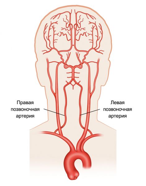 Стеноз позвоночной артерии