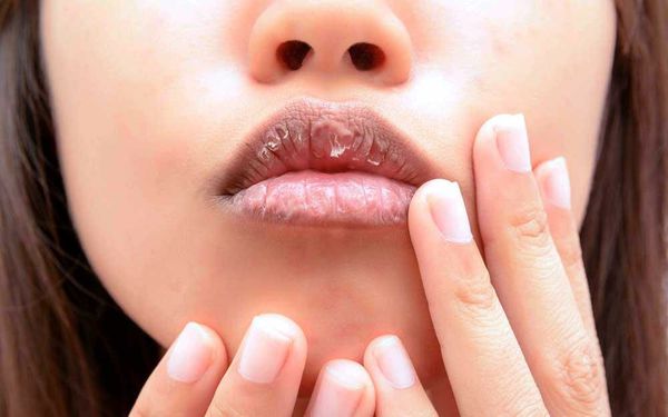 Сухие губы при ксеростомии 
