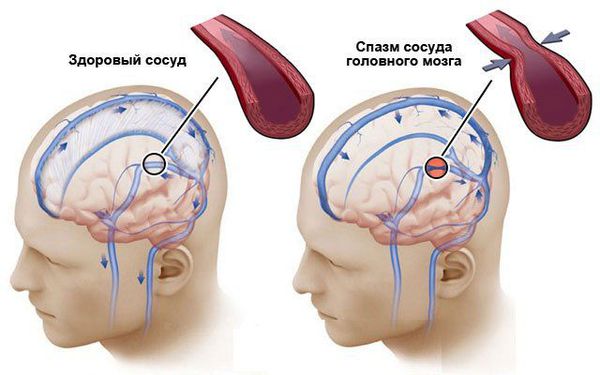 Сужение мозговых артерий