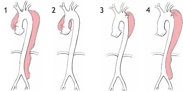 Типы расслоения аорты