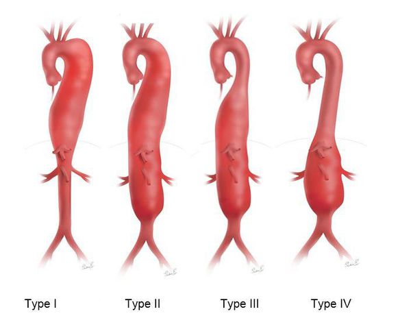 Типы торакоабдоминальных (грудо-брюшных) аневризм
