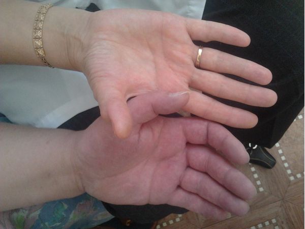 Посиневшая рука пациентки по сравнению со здоровой рукой