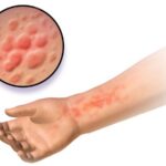 https://dgp1nn.ru/blog/wp-content/uploads/toksikodermiya-toksiko-allergicheskiy-dermatit-s.jpg