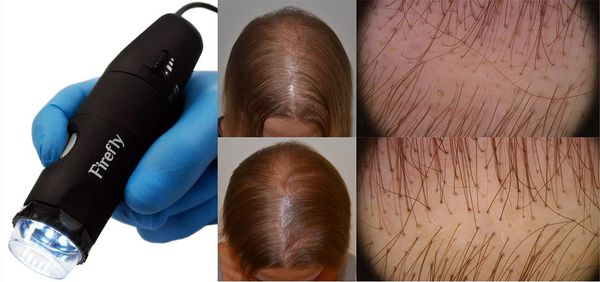 Трихоскопия: состояние кожи головы и волос при диффузной алопеции