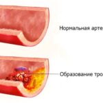 https://dgp1nn.ru/blog/wp-content/uploads/tromboz-arterii-s.jpg