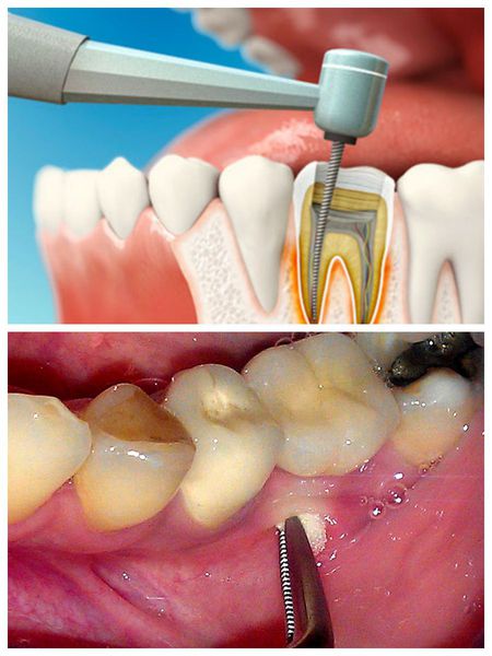 Варианты оперативного лечения абсцесса зуба