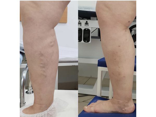 До и через 11 месяцев после операции на правой ноге