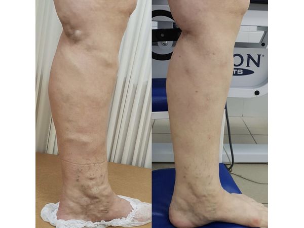 До и через 11 месяцев после операции на левой ноге