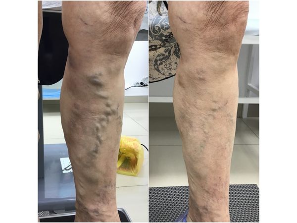 Передняя часть левой ноги до и через 2 месяца после лечения