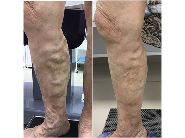 Передняя часть правой ноги до и через 2 месяца после лечения