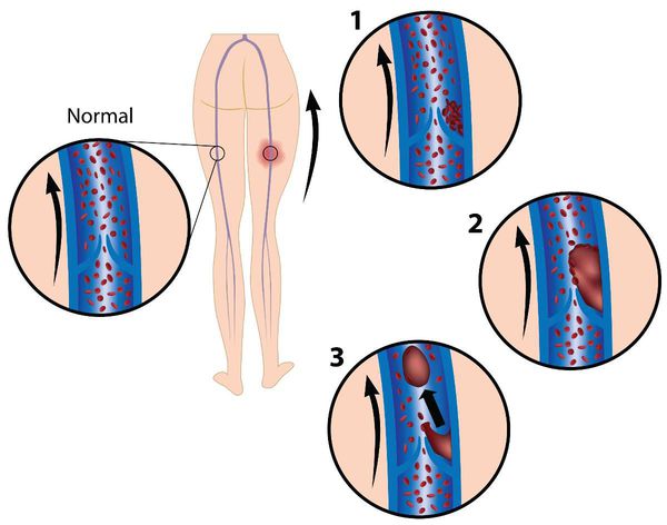Венозный тромбоз начинается у венозных клапанов