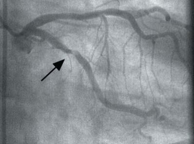 Визуализация суженной артерии при помощи коронарной ангиографии