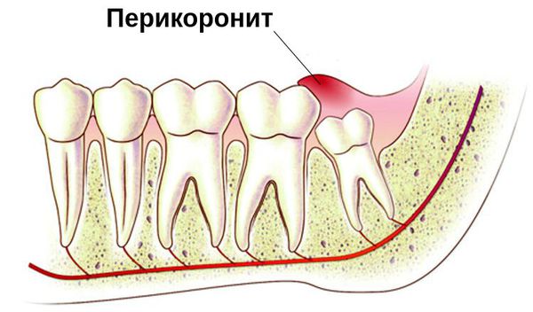 Воспаление десны над прорезающимся зубом