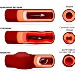 https://dgp1nn.ru/blog/wp-content/uploads/vospalenie-i-anevrizma-arterii-s.jpeg