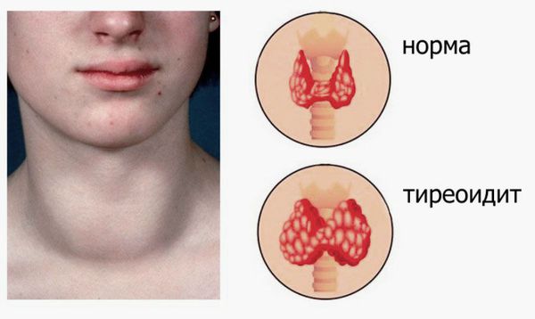 Воспаление щитовидной железы