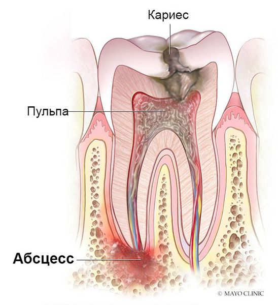 Воспаление тканей под корнем зуба