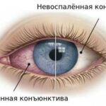 https://dgp1nn.ru/blog/wp-content/uploads/vospalyonnaya-konyunktiva-s.jpg