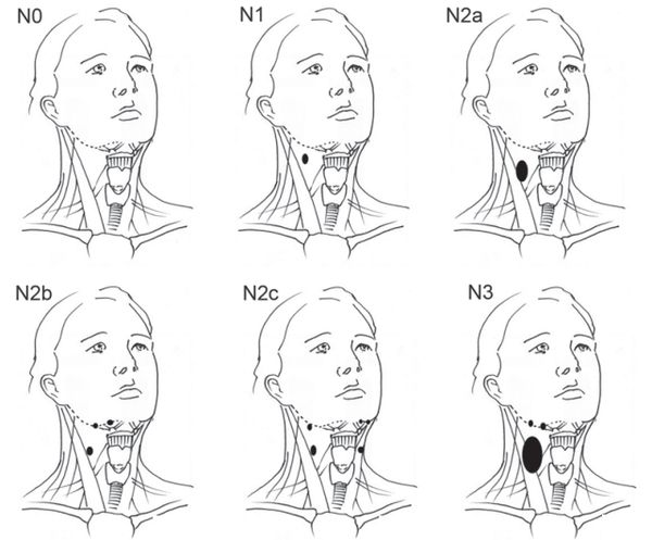 Вовлечение лимфатических узлов при раке полости носа и пазух