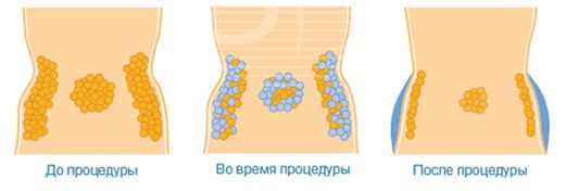 Воздействие криолиполиза на жировые клетки