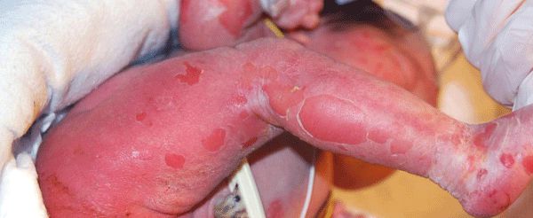 Врождённая буллёзная ихтиозиформная эритродермия 