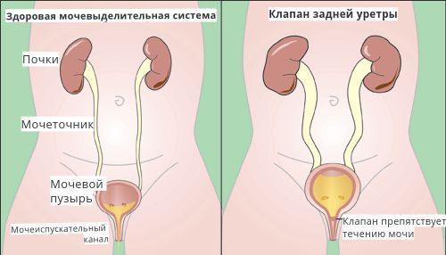 Врождённый клапан задней уретры