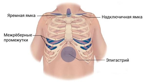 Втяжение уступчивых мест грудной клетки