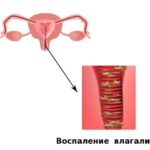 https://dgp1nn.ru/blog/wp-content/uploads/vulvovaginit-simptomy-i-lechenie_2.jpg
