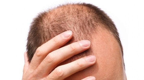 Выпадение волос, связанное с нехваткой мужских половых гормонов