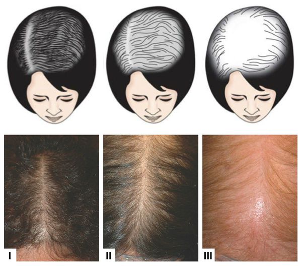 Выраженность потери волос у женщин по шкале Людвига