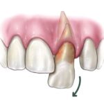 https://dgp1nn.ru/blog/wp-content/uploads/vyvih-zuba-s-povrezhdeniem-periodonta-s.jpg