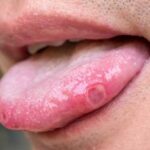 Ярко красный язык: причины, симптомы и методы лечения