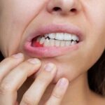 Язвочка на внутренней поверхности щеки: причины, симптомы и способы лечения
