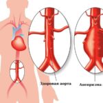 https://dgp1nn.ru/blog/wp-content/uploads/zdorovaya-aorta-i-anevrizma-aorty-s.jpg