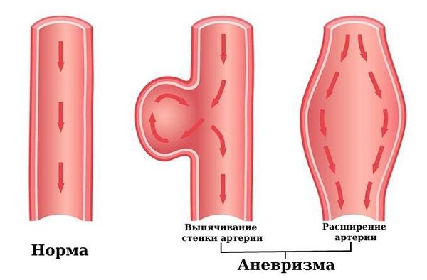 Здоровая артерия и аневризма