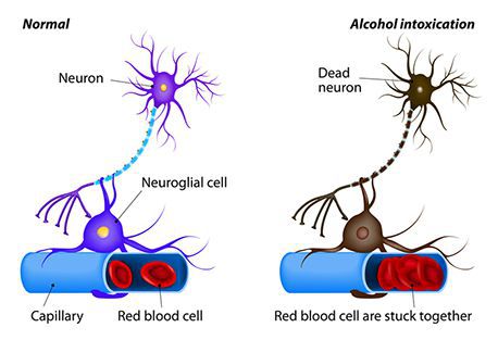 Здоровый и повреждённый нейрон