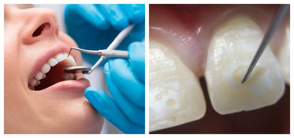 Зондирование гипоплазированного зуба