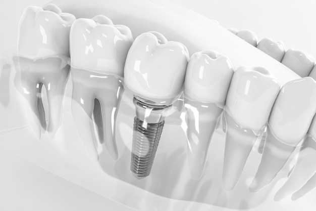 Процесс установки зубных имплантов Xive